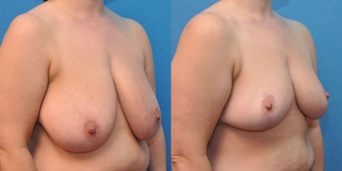 Breast Reduction #6 - Before and After