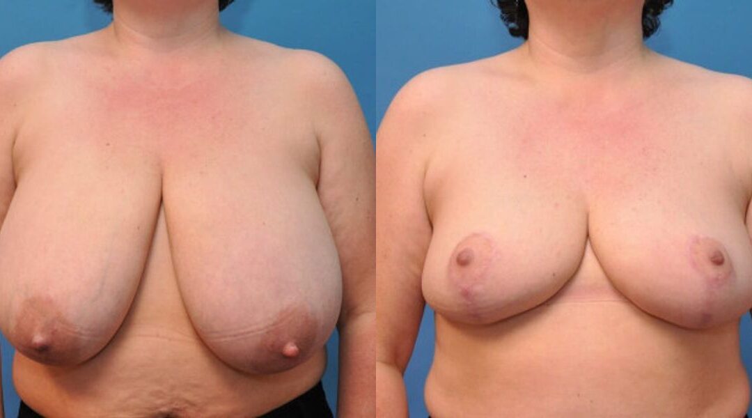 Breast Reduction #7