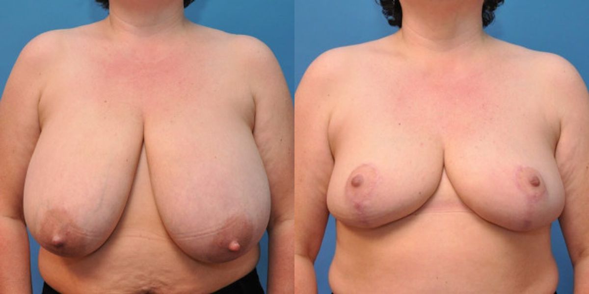 Breast Reduction #7 - Before and After