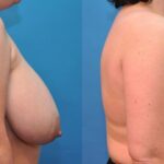Breast Reduction #7 - Before and After