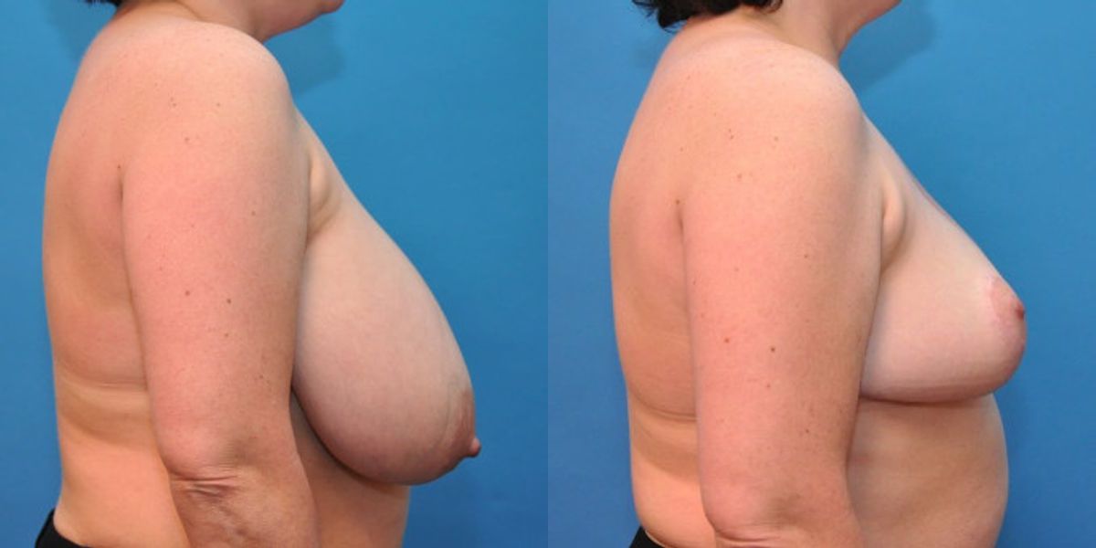 Breast Reduction #7 - Before and After