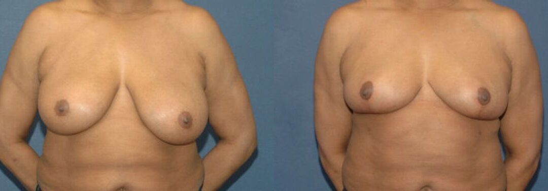 Breast Reduction #8