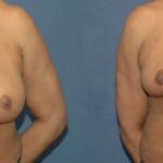 Breast Reduction #8 - Before and After