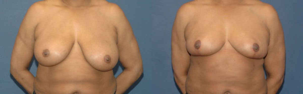 Breast Reduction #8 - Before and After