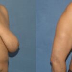 Breast Reduction #8 - Before and After