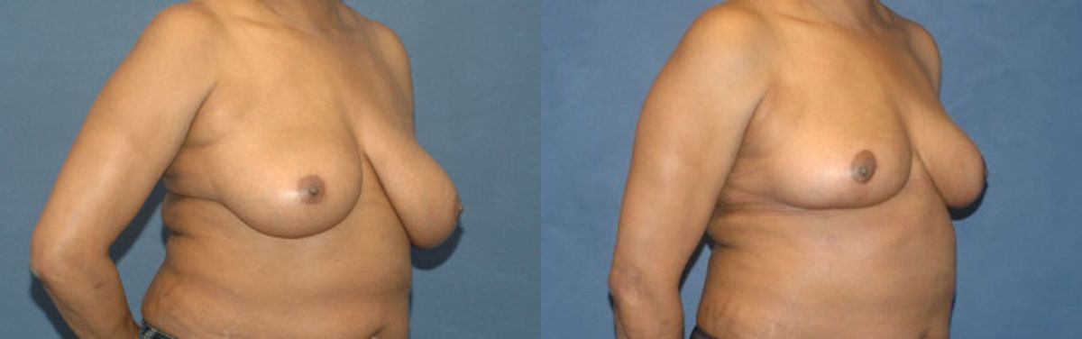Breast Reduction #8 - Before and After