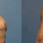 Breast Reduction #8 - Before and After