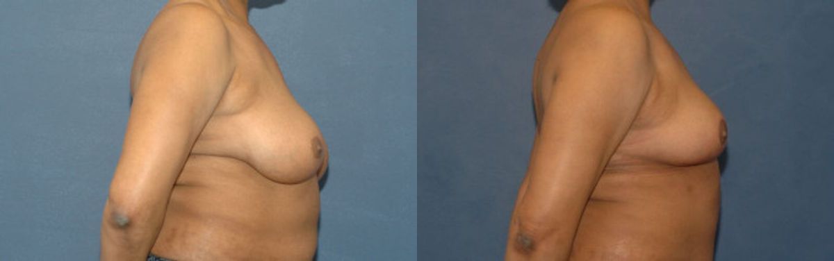 Breast Reduction #8 - Before and After