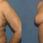 Breast Reduction #8 - Before and After