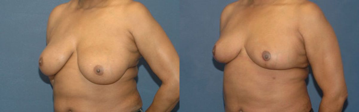 Breast Reduction #8 - Before and After