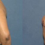 Breast Reduction #8 - Before and After