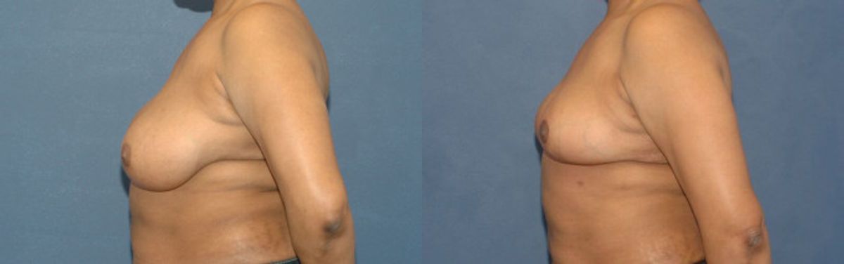 Breast Reduction #8 - Before and After