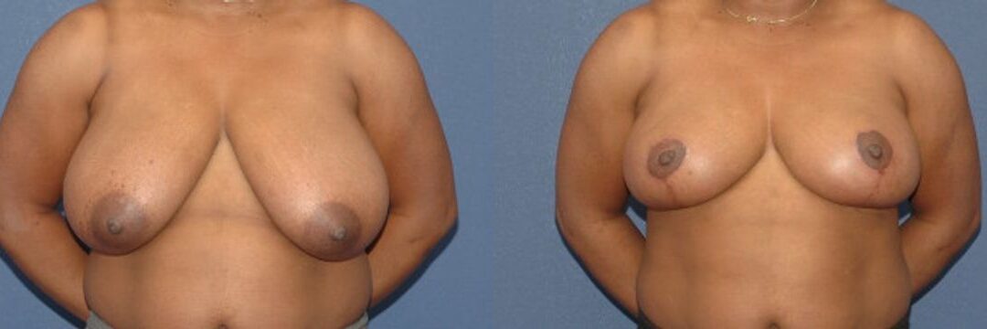 Breast Reduction #9
