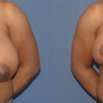 Breast Reduction #9 - Before and After