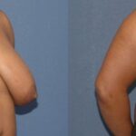 Breast Reduction #9 - Before and After