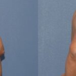 Breast Reduction #9 - Before and After