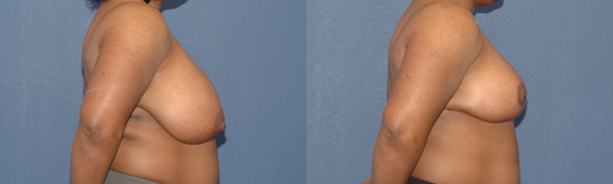 Breast Reduction #9 - Before and After
