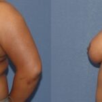 Breast Reduction #9 - Before and After