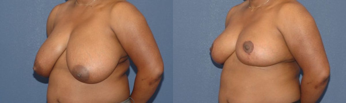 Breast Reduction #9 - Before and After
