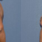 Breast Reduction #9 - Before and After