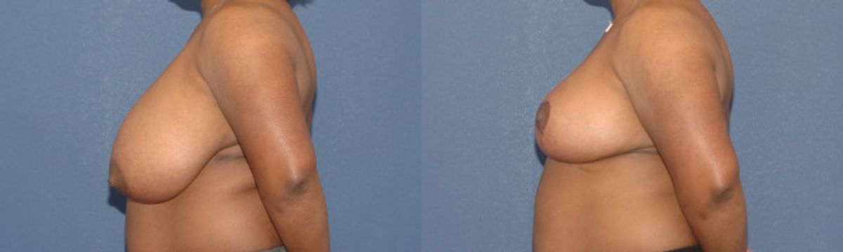 Breast Reduction #9 - Before and After