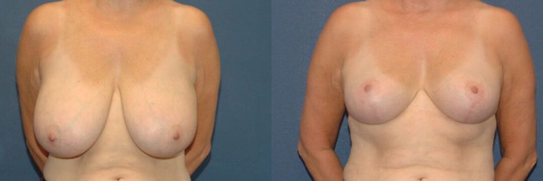 Breast Reduction #10