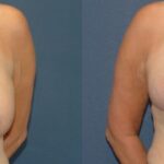 Breast Reduction #10 - Before and After