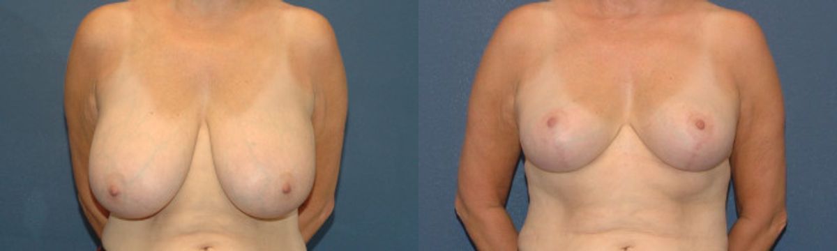 Breast Reduction #10 - Before and After