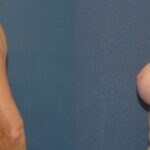 Breast Reduction #10 - Before and After