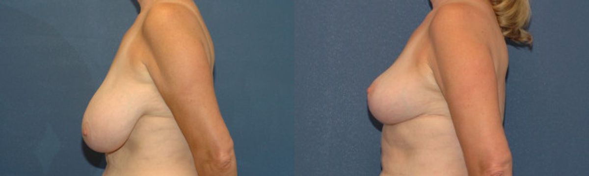 Breast Reduction #10 - Before and After