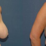 Breast Reduction #10 - Before and After
