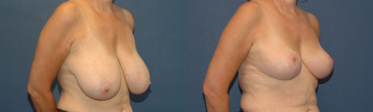 Breast Reduction #10 - Before and After
