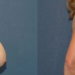 Breast Reduction #10 - Before and After