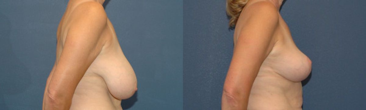 Breast Reduction #10 - Before and After
