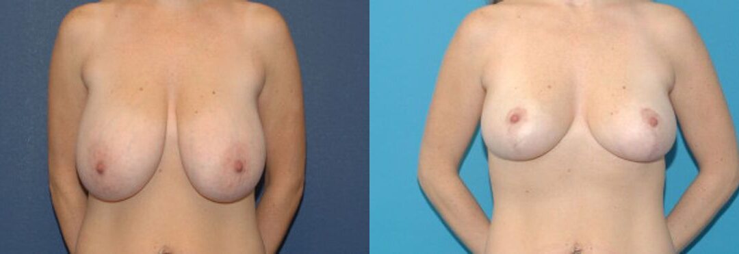 Breast Reduction #11