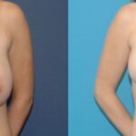 Breast Reduction #11 - Before and After