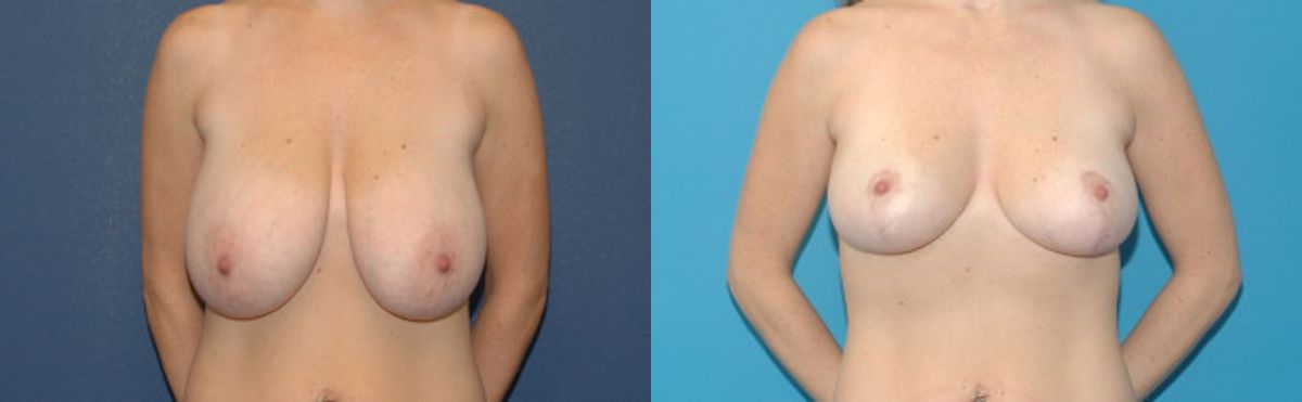 Breast Reduction #11 - Before and After