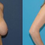 Breast Reduction #11 - Before and After