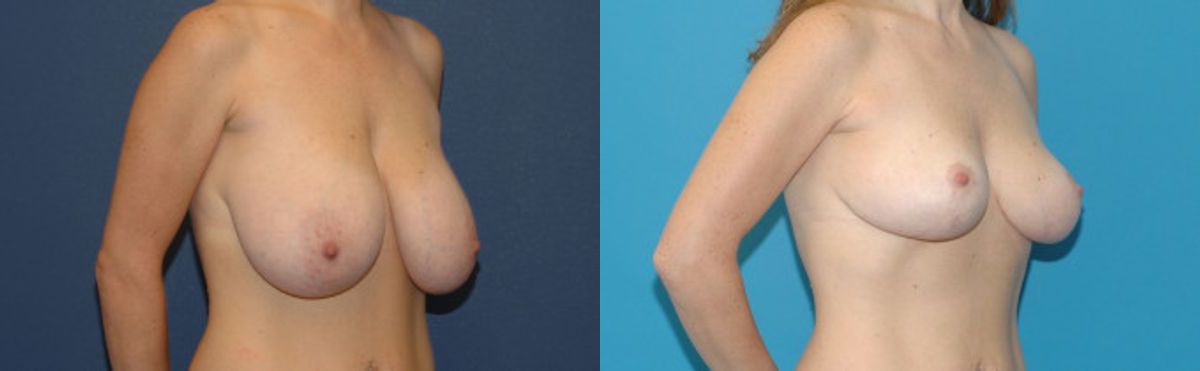 Breast Reduction #11 - Before and After