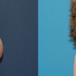 Breast Reduction #11 - Before and After