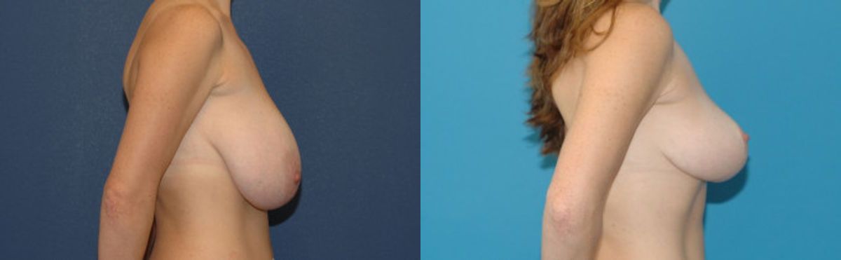 Breast Reduction #11 - Before and After