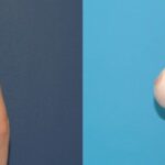 Breast Reduction #11 - Before and After