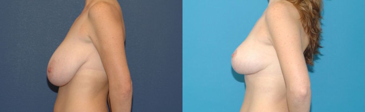 Breast Reduction #11 - Before and After