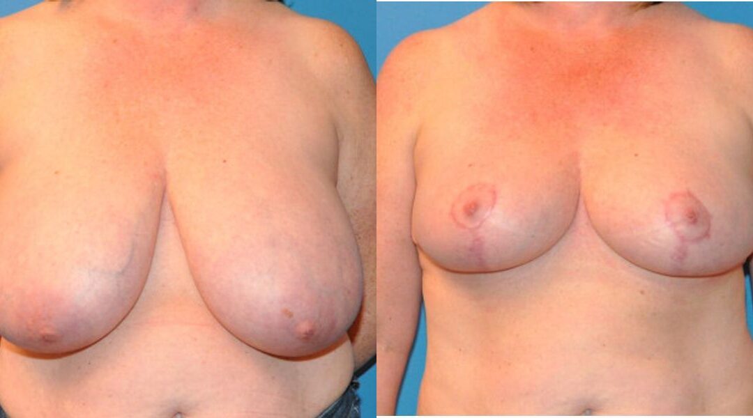 Breast Reduction #12