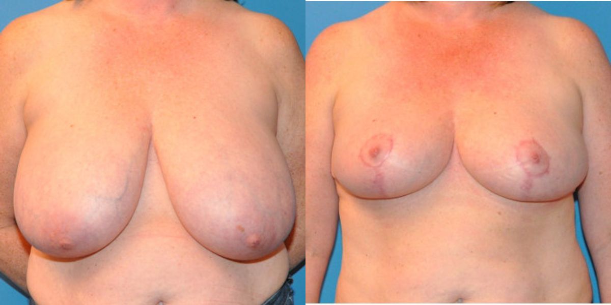 Breast Reduction #12 - Before and After