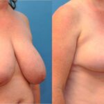 Breast Reduction #12 - Before and After