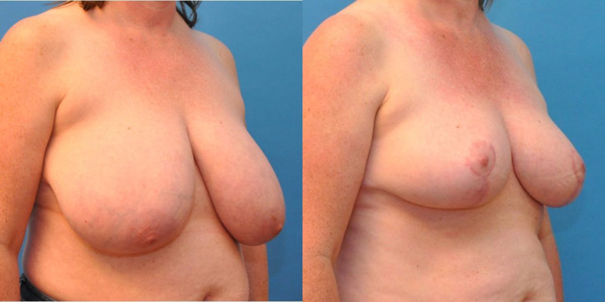 Breast Reduction #12 - Before and After