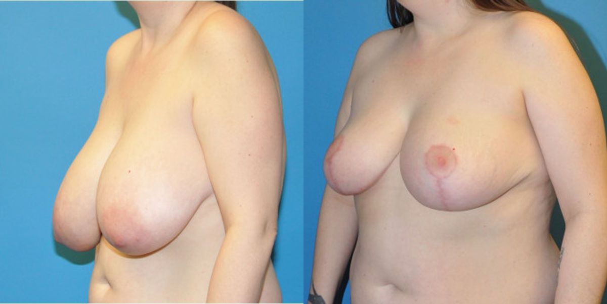 Breast Reduction #13 - Before and After