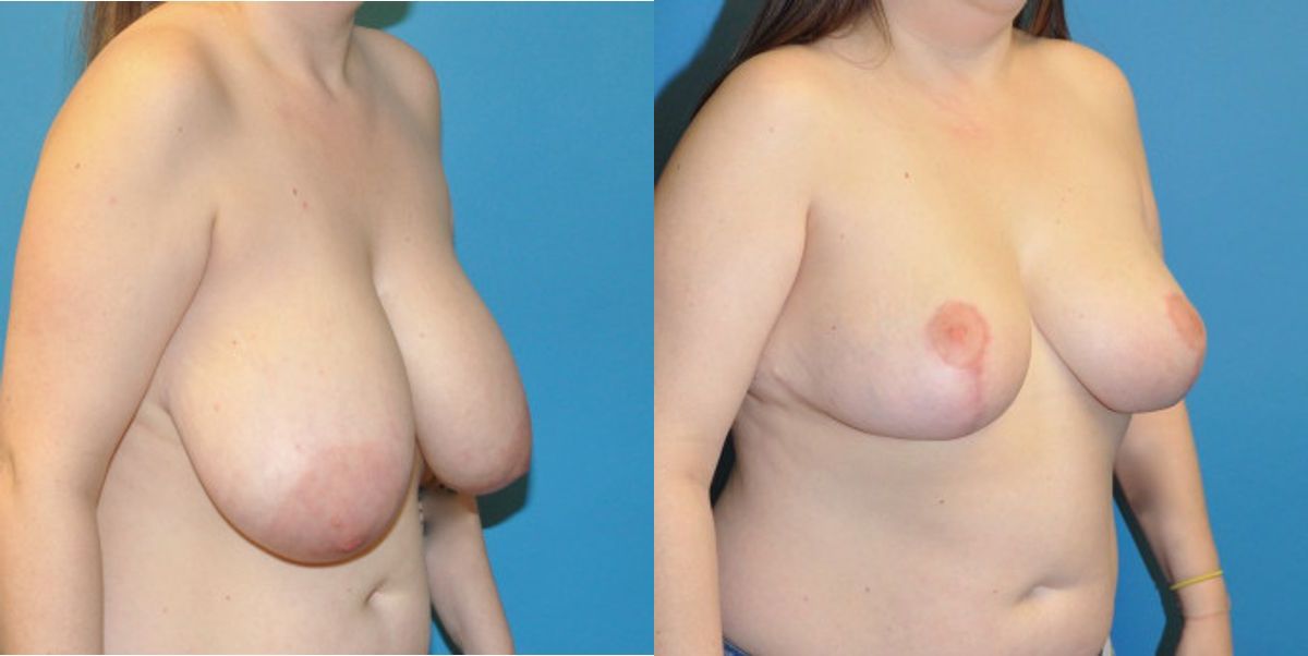 Breast Reduction #13 - Before and After