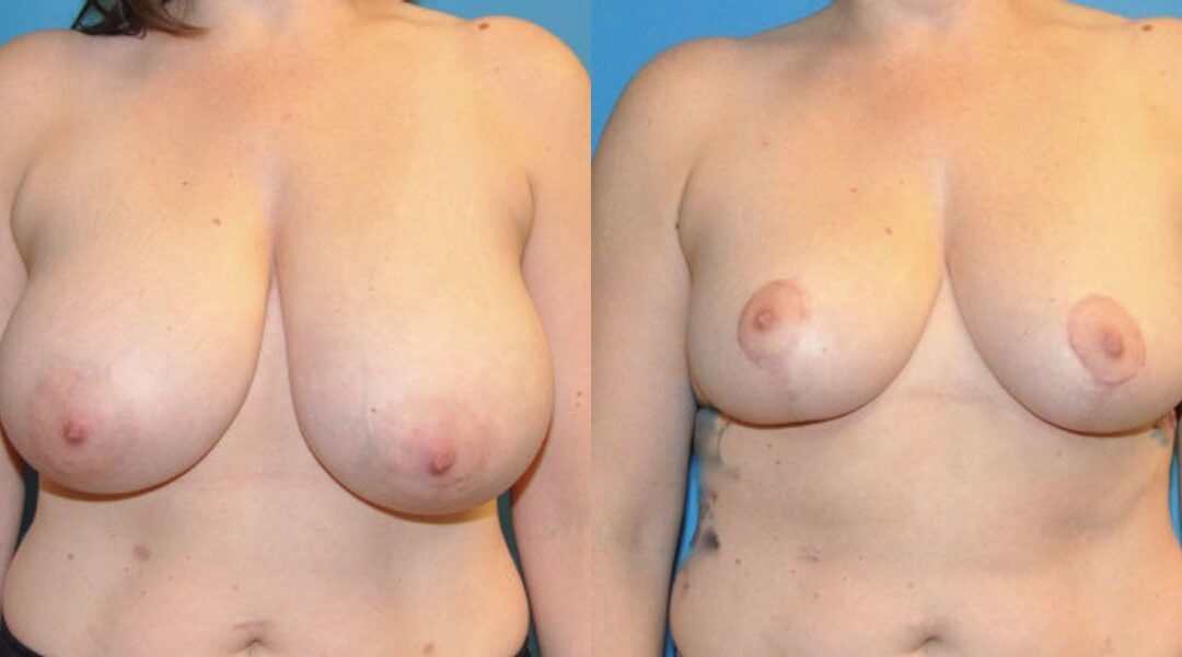 Breast Reduction #14